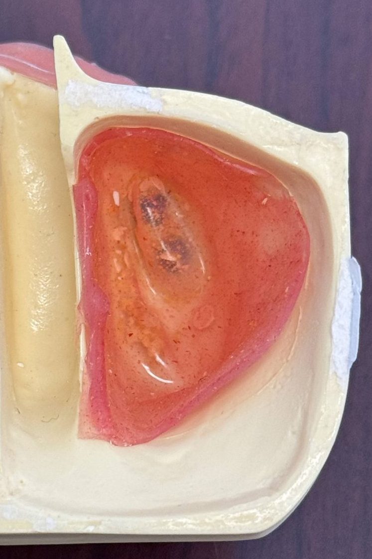 Sinus Augmentation Procedures: Defining New Protocols and Surgical